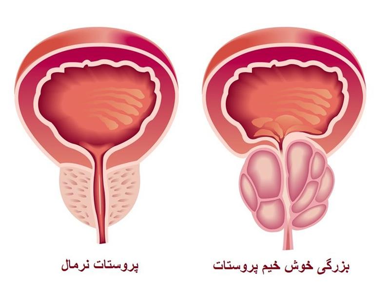 بزرگی پروستات